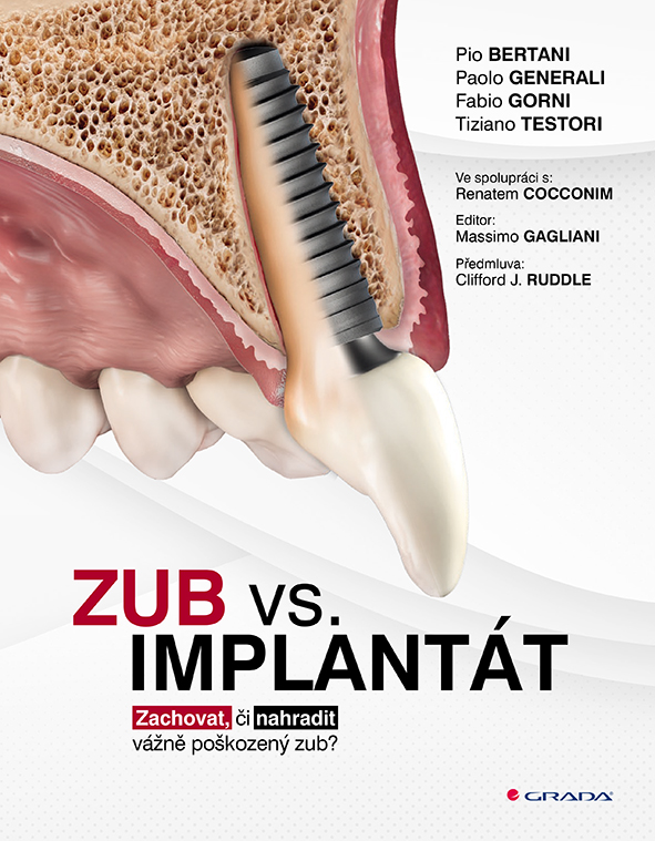 Zub vs. implantát - Pio Bertani, Paolo Generali, Fabio Gorni, Tiziano Testori